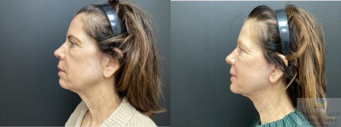 Before & After Facelift/Necklift Case 56 Left Side View in Rochester, NY