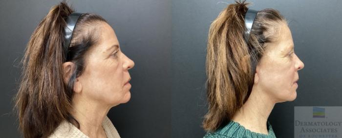 Before & After Facelift/Necklift Case 56 Right Side View in Rochester, NY