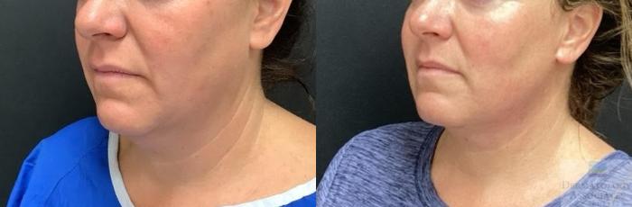 Before & After Facelift/Necklift Case 84 Angle View in Rochester, NY