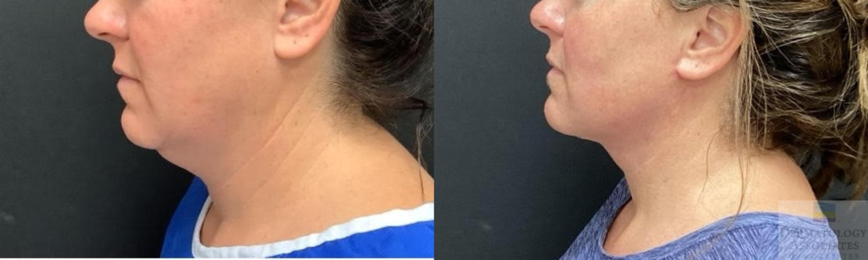Before & After Facelift/Necklift Case 84 Left Side View in Rochester, NY