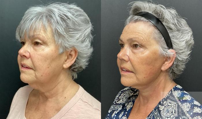 Before & After Facelift/Necklift Case 94 Angle View in Rochester, NY