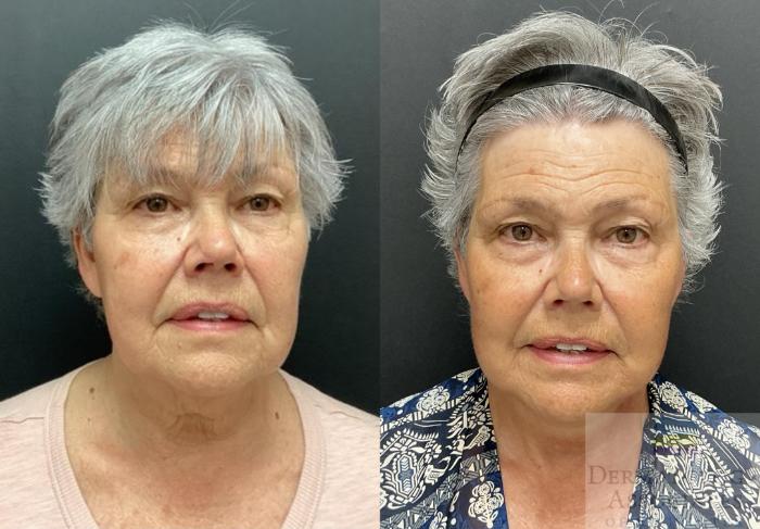 Before & After Facelift/Necklift Case 94 Front View in Rochester, NY