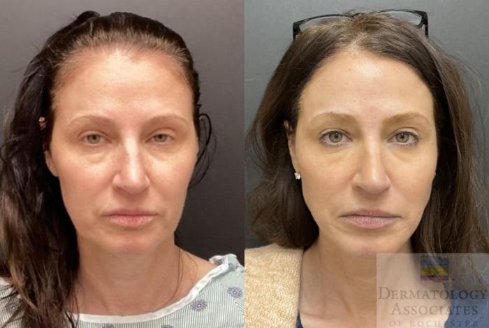 Before & After Facelift/Necklift Case 99 Front View in Rochester, NY