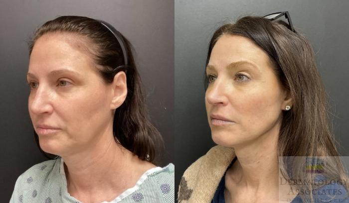 Before & After Facelift/Necklift Case 99 Left Angle View in Rochester, NY