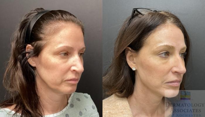 Before & After Facelift/Necklift Case 99 Right Angle View in Rochester, NY