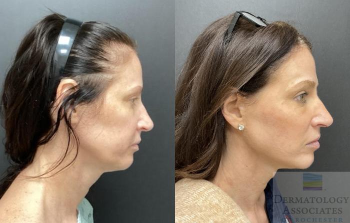 Before & After Facelift/Necklift Case 99 Right Side View in Rochester, NY