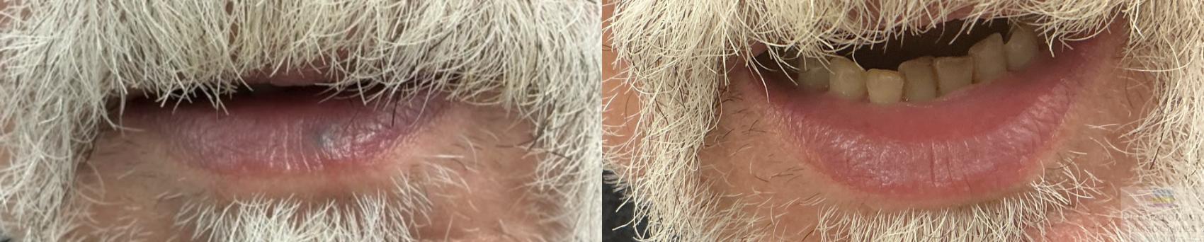 Before & After GentleMax Case 93 Front View in Rochester, NY