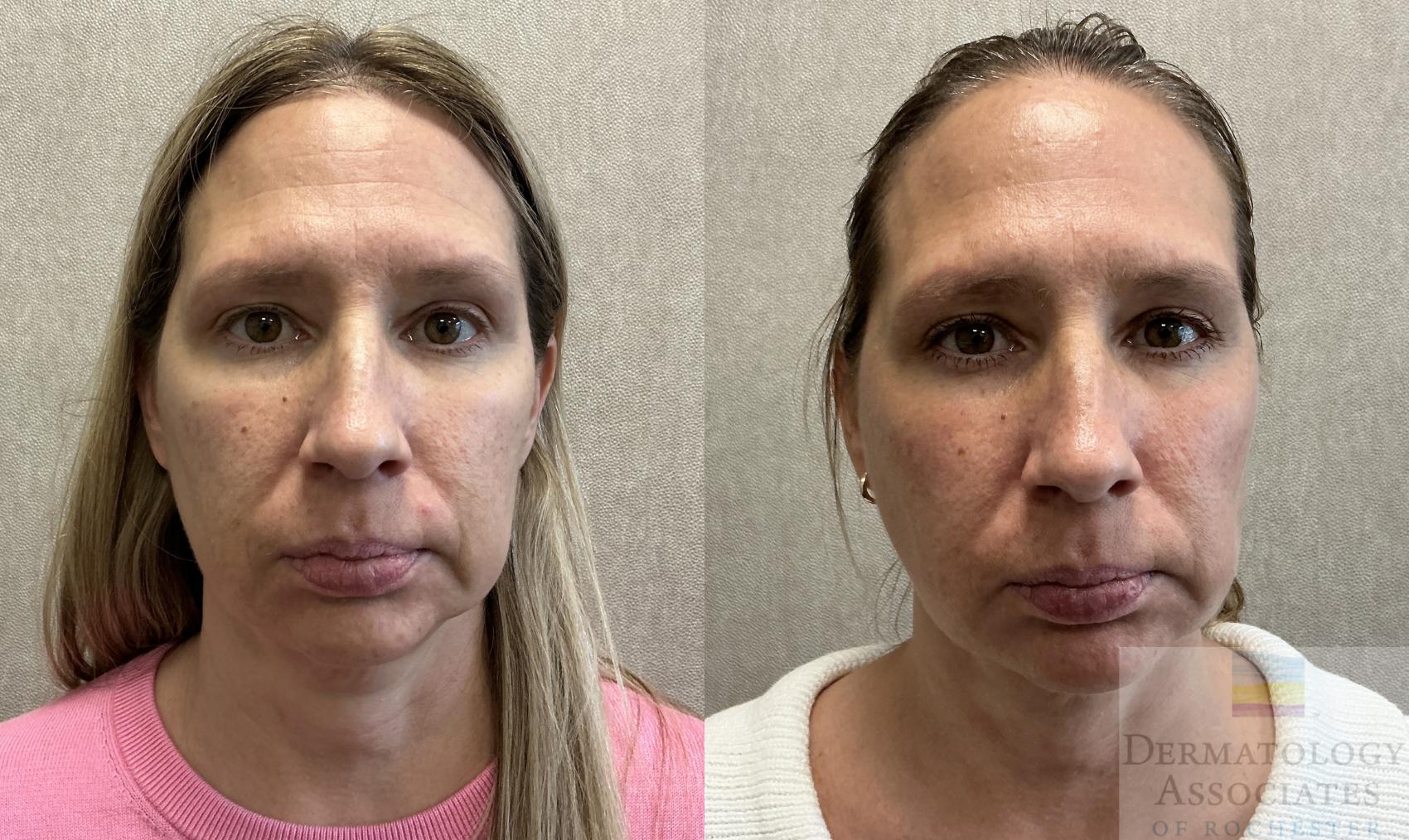 Before & After Halo Tribrid Case 129 Front View in Rochester, NY