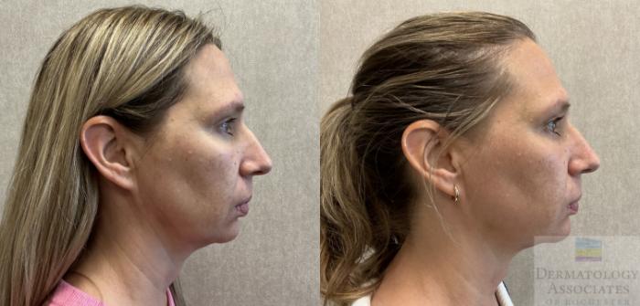 Before & After Halo Tribrid Case 129 Right Side View in Rochester, NY
