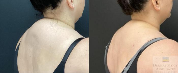 Before & After Liposuction Case 107 Right Side Angle View in Rochester, NY