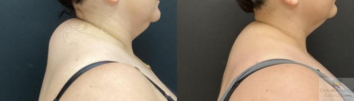 Before & After Liposuction Case 107 Right Side View in Rochester, NY