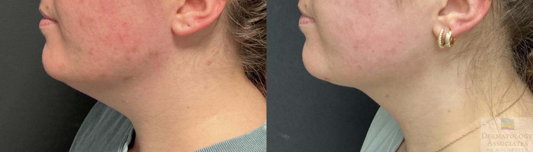 Before & After Liposuction Case 113 Left Side View in Rochester, NY