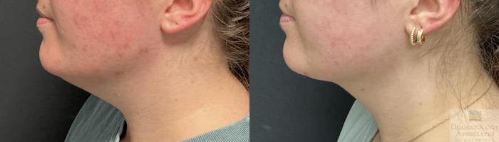 Before & After Liposuction Case 113 Left Side View in Rochester, NY