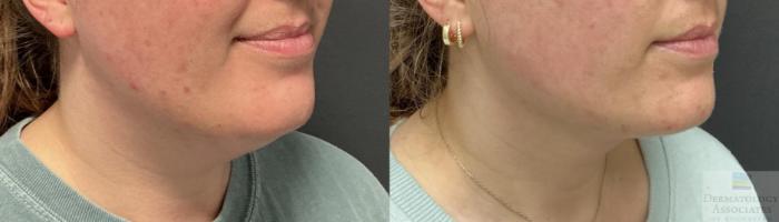Before & After Liposuction Case 113 Right Side Angle View in Rochester, NY
