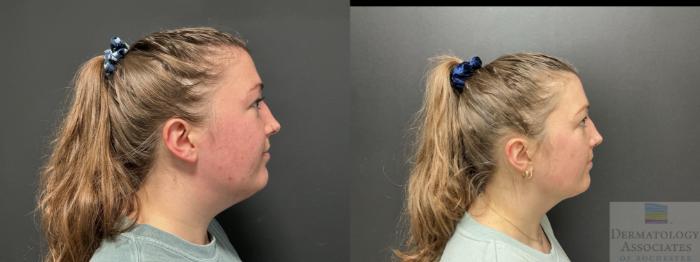 Before & After Liposuction Case 113 Right Side View in Rochester, NY