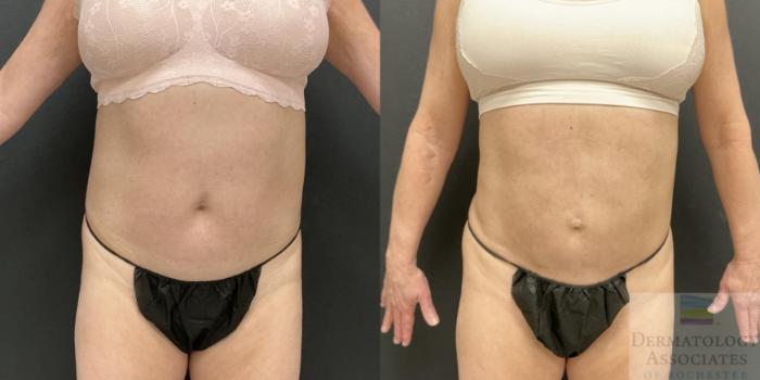 Before & After Liposuction Case 114 Front View in Rochester, NY