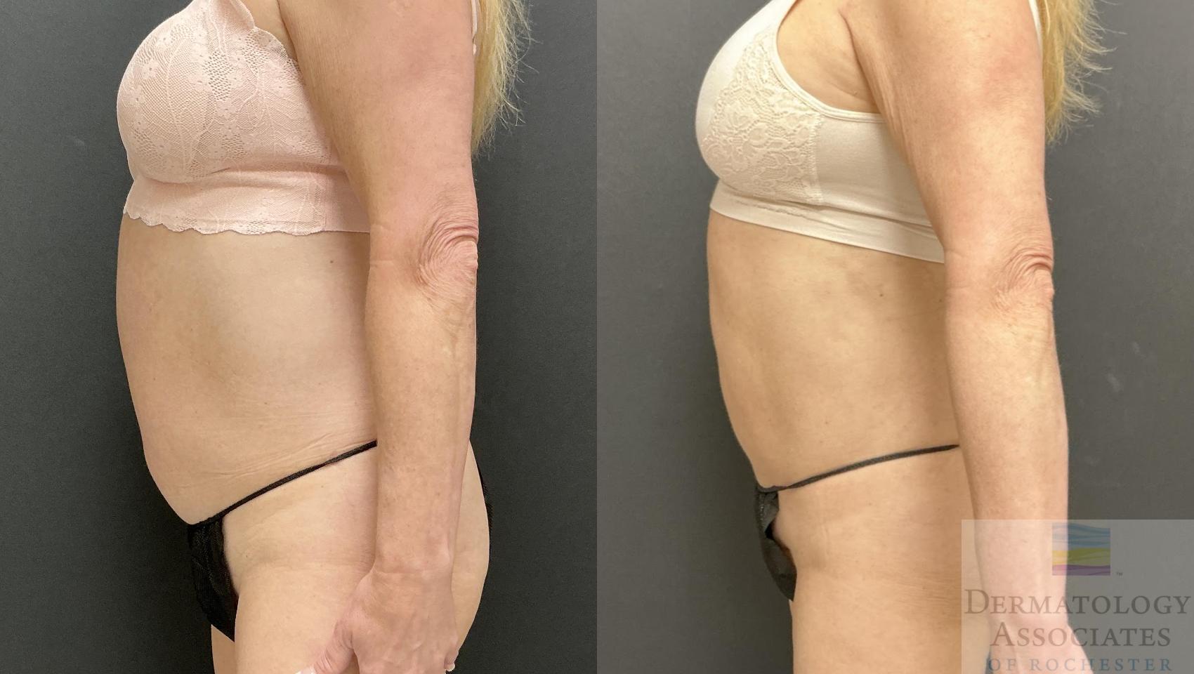 Before & After Liposuction Case 114 Left Side View in Rochester, NY