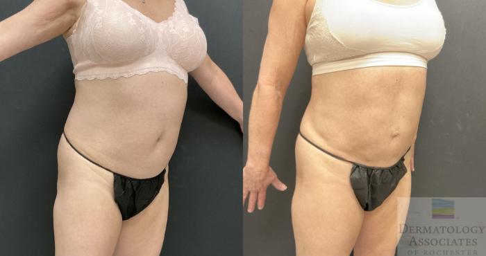 Before & After Liposuction Case 114 Right Side Angle View in Rochester, NY