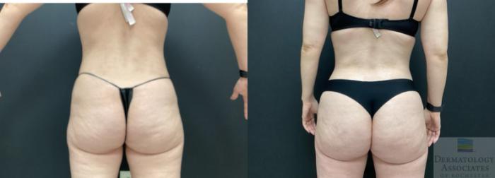 Before & After Cellulite - Aveli Case 40 Back View in Rochester, NY