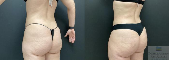 Before & After Cellulite - Aveli Case 40 Left Posterior View in Rochester, NY