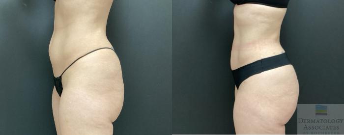 Before & After Cellulite - Aveli Case 40 Left Side View in Rochester, NY