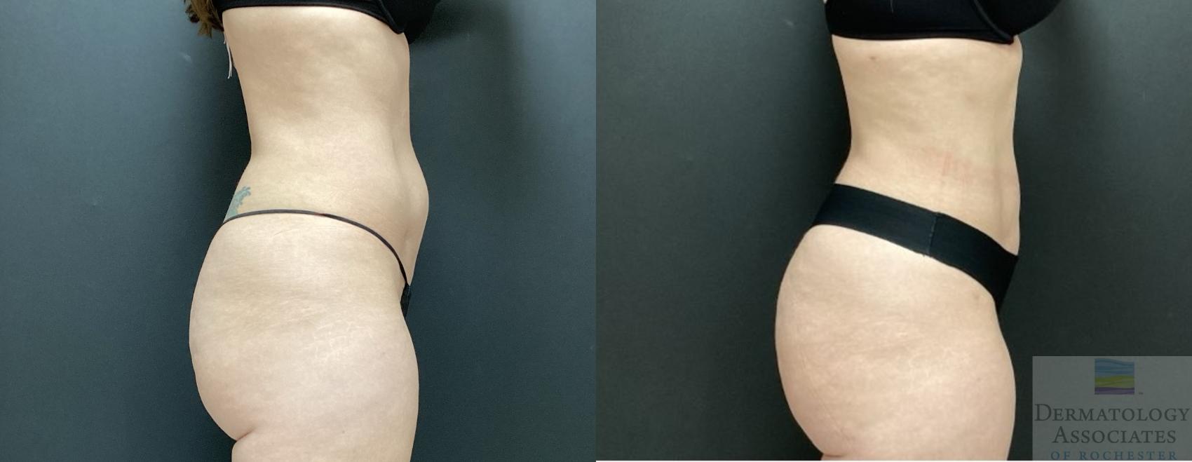 Before & After Cellulite - Aveli Case 40 Right Side View in Rochester, NY