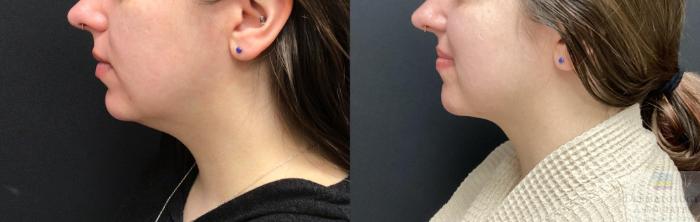 Before & After Liposuction Case 66 Left Side View in Rochester, NY