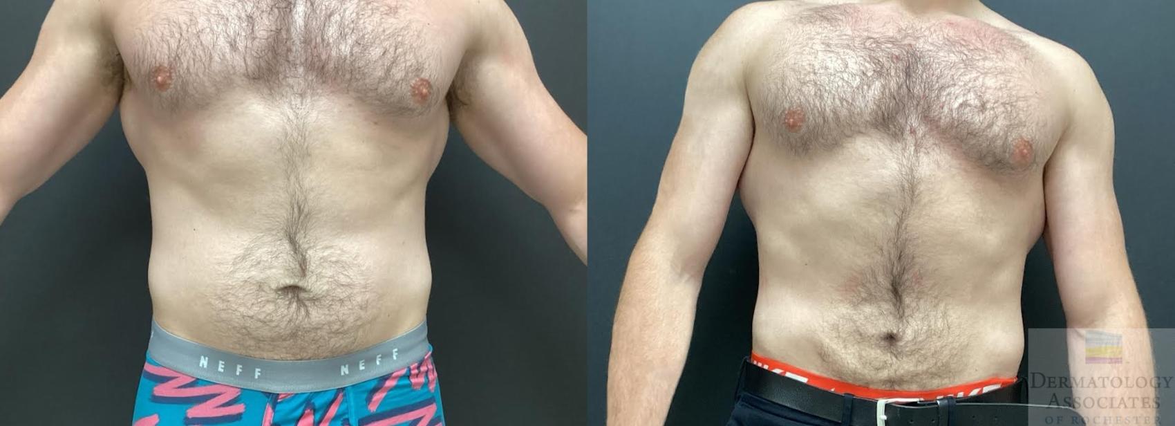 Before & After Liposuction Case 67 Front View in Rochester, NY