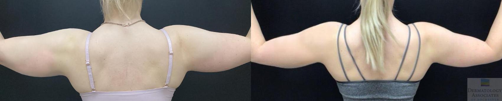 Before & After Liposuction Case 86 Back View in Rochester, NY