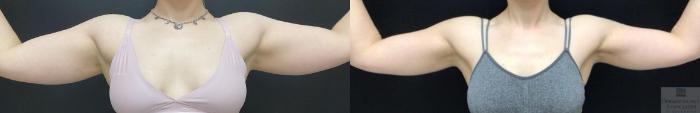 Before & After Liposuction Case 86 Front View in Rochester, NY