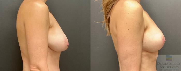 Before & After Mastopexy - breast lift Case 134 Right Side View in Rochester, NY