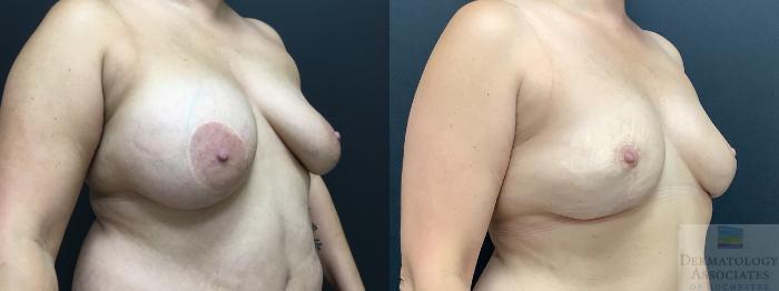 Before & After Mastopexy - breast lift Case 16 Right Oblique View in Rochester, NY