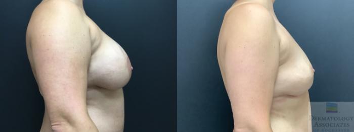 Before & After Mastopexy - breast lift Case 16 Right Side View in Rochester, NY