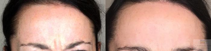 Before & After Neurotoxin Case 27 Front- glabella View in Rochester, NY