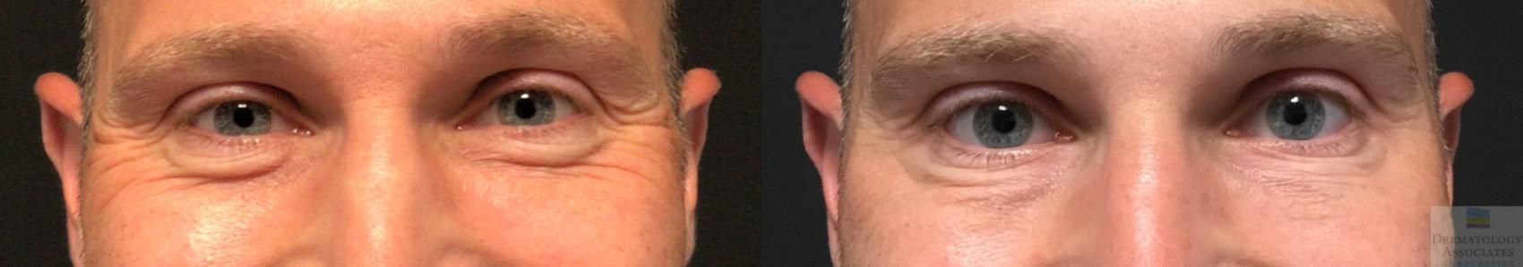 Before & After Neurotoxin Case 28 Front- crows feet View in Rochester, NY