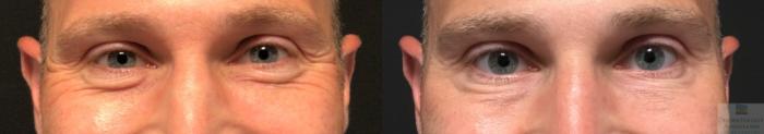 Before & After Neurotoxin Case 28 Front- crows feet View in Rochester, NY