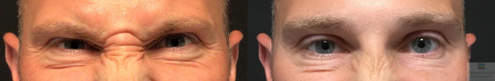 Before & After Neurotoxin Case 28 Front- glabella/nasalis View in Rochester, NY