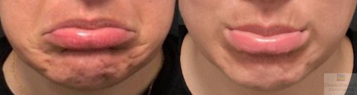 Before & After Neurotoxin Case 29 Front- chin/DAO View in Rochester, NY
