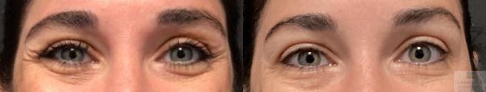 Before & After Neurotoxin Case 29 Front- crows feet View in Rochester, NY