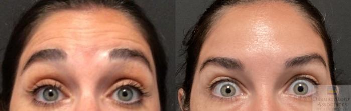 Before & After Neurotoxin Case 29 front- forehead View in Rochester, NY