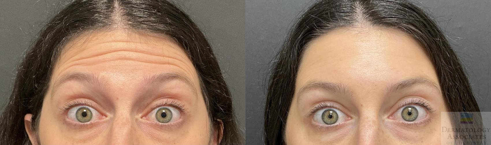 Before & After Neurotoxin Case 95 Front - Forehead View in Rochester, NY