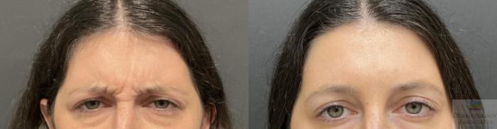 Before & After Neurotoxin Case 95 Front - Glabella View in Rochester, NY