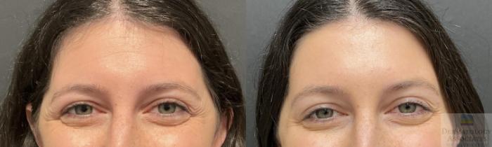Before & After Neurotoxin Case 95 Front - Periorbital View in Rochester, NY