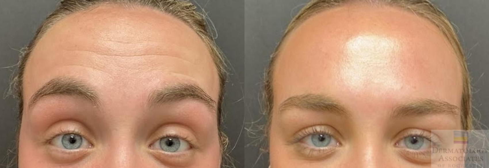 Before & After Neurotoxin Case 96 Front - Forehead View in Rochester, NY