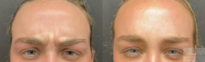 Before & After Neurotoxin Case 96 Front - Glabella View in Rochester, NY