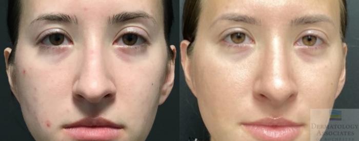 Before & After Rhinoplasty Case 17 Front View in Rochester, NY