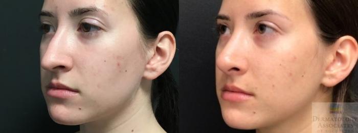 Before & After Rhinoplasty Case 17 Left Oblique View in Rochester, NY