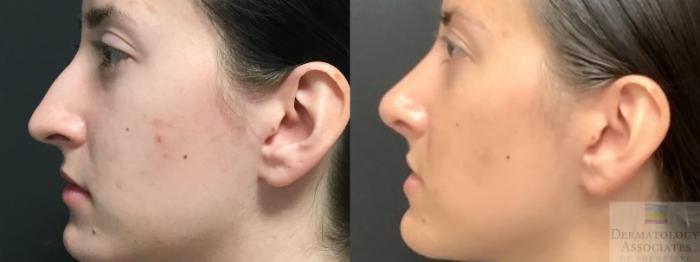 Before & After Rhinoplasty Case 17 Left Side View in Rochester, NY