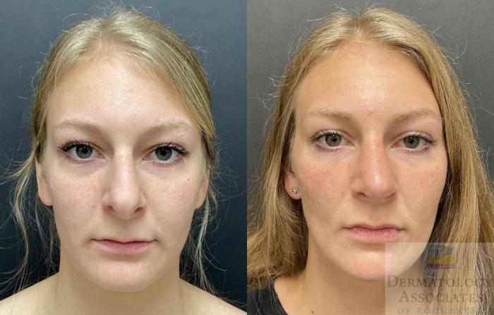Before & After Rhinoplasty Case 92 Front View in Rochester, NY