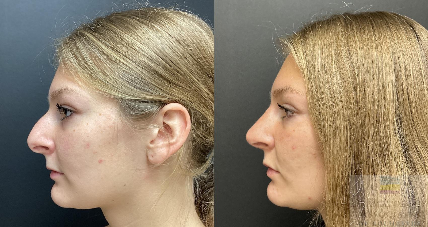 Before & After Rhinoplasty Case 92 Left Side View in Rochester, NY
